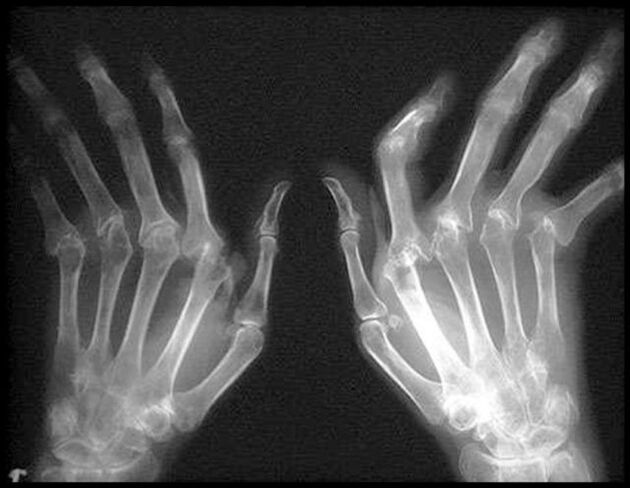 X -Ray Arthrosz-қа әсер ететін қолдардың суреті
